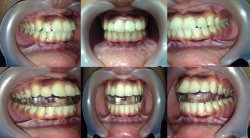 Hegab TMJ Splint (HTS)6